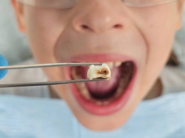 Best Emergency Dental Care for Sports Injuries in Burkburnett, TX